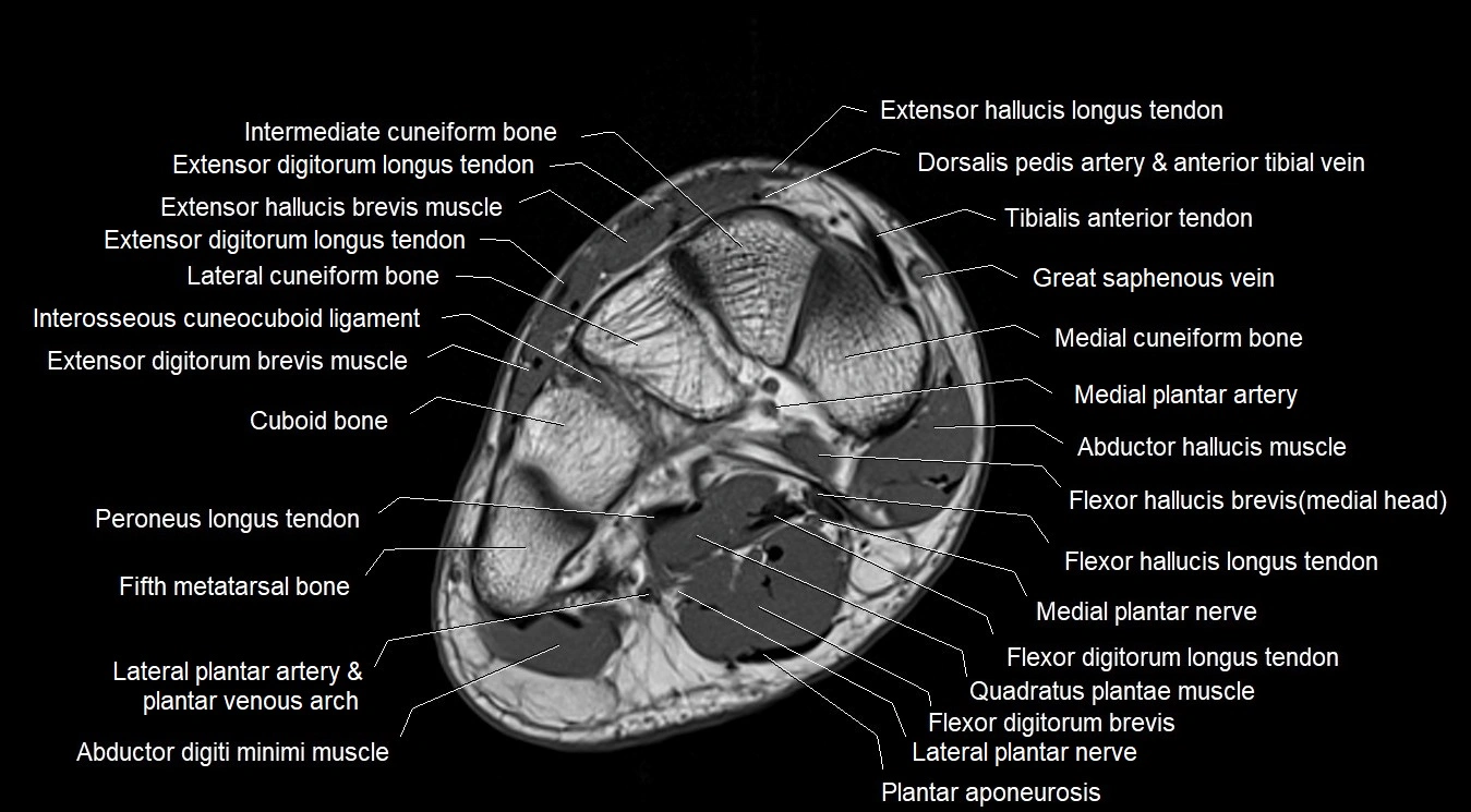 MRI 3T foot axial cross sectional anatomy image 8.webp